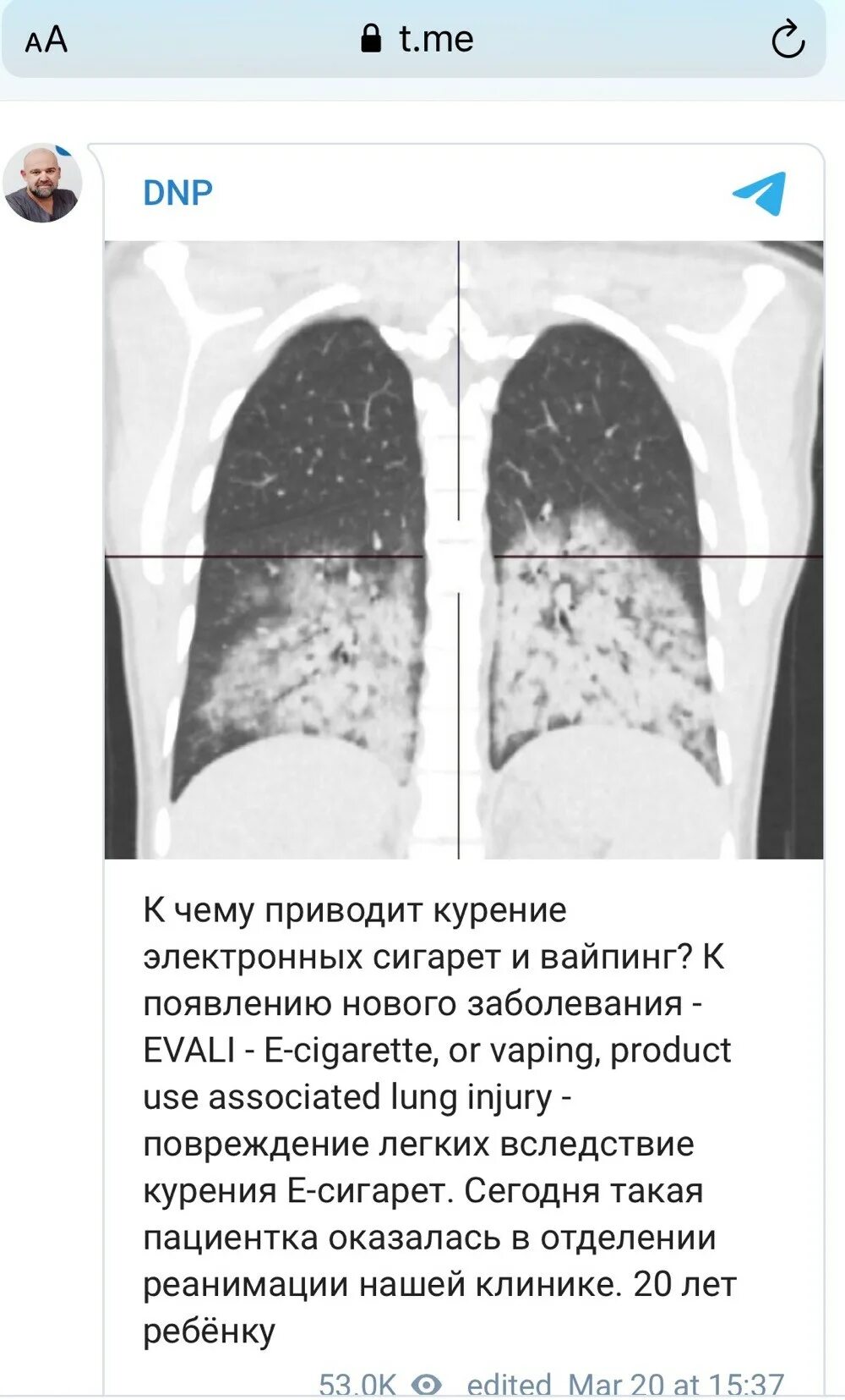 вейп-ассоциированные пневмонии. легкие курильщика вейпа. лёгкие электронные сигареты. пневмония после электронных сигарет. люгкиепосле вейпа и сигарет.