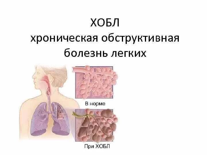 Хронические легочные заболевания. Хроническая обструктивная болезнь легких. Обструктивные заболевания легких. Хроническая обструктивная болезнь легких (ХОБЛ).