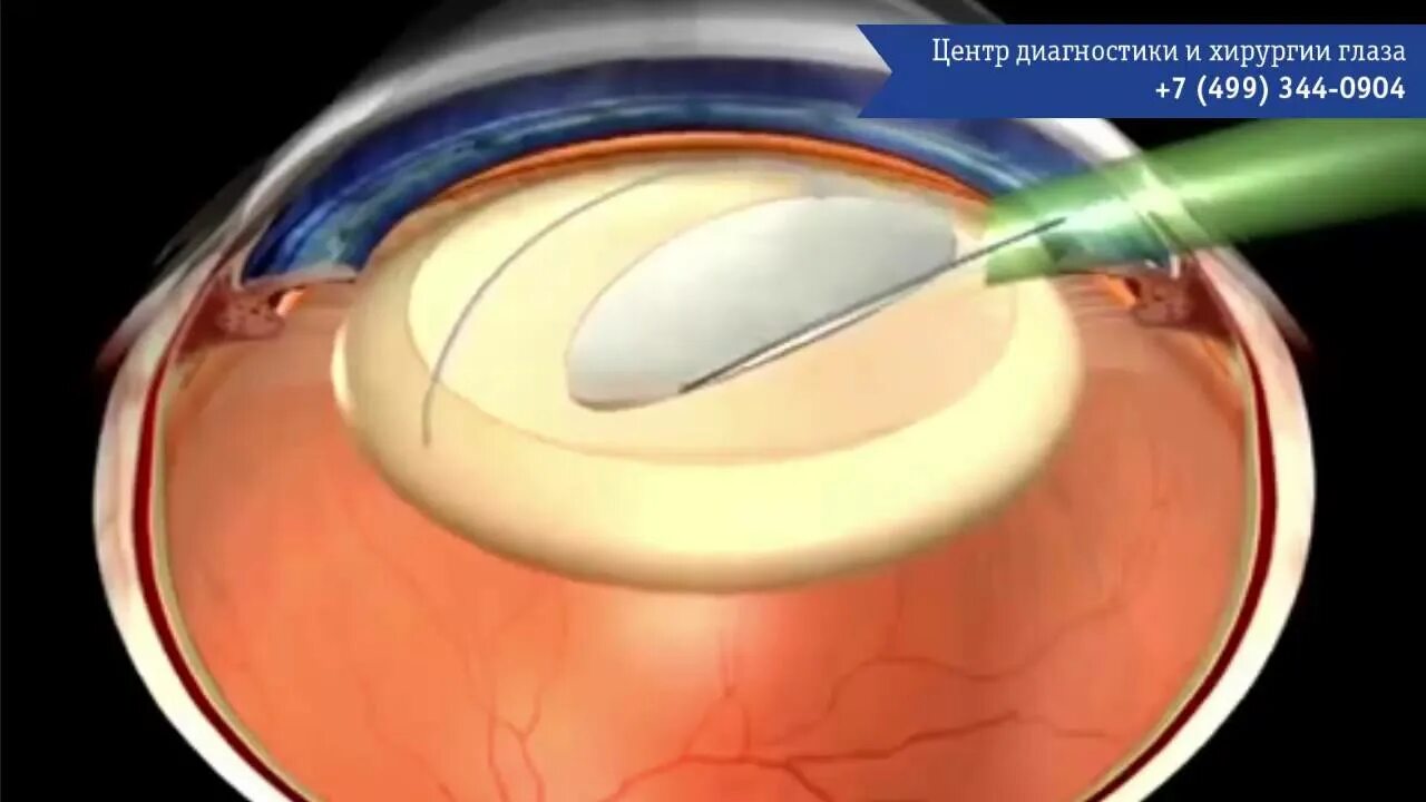 Замена хрусталика глаза как проходит операция. Ультразвуковая факоэмульсификация катаракты. Операция факоэмульсификация катаракты. Хирургия катаракты с имплантацией ИОЛ.