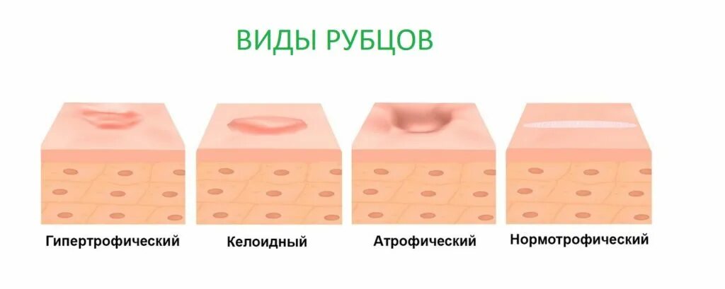 Образование шрамов