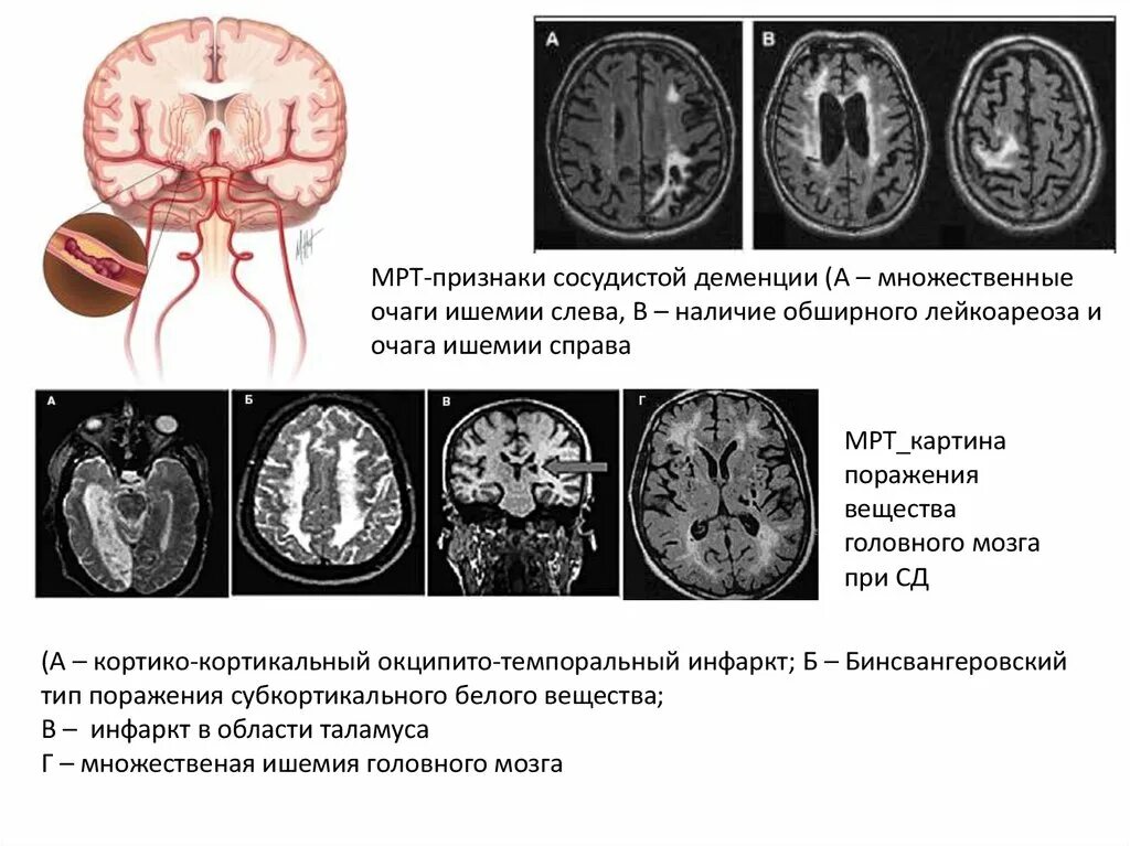 Очаги ишемии головного мозга. Очаги ишемии головного мозга на мрт. Сосудистая деменция мрт. Очаг ишемии головного мозга на кт. Мрт головного мозга при сосудистой деменции.