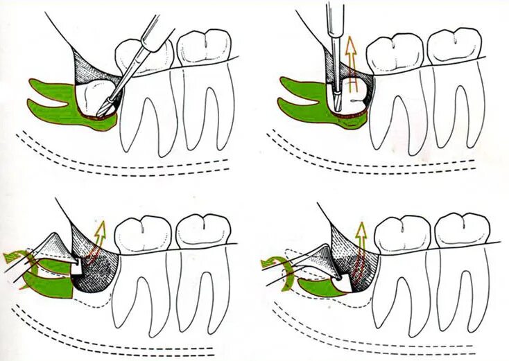 Лечение зуба 8. Технология вырывания зуба мудрости. Ретинированный зуб мудрости операция. Операция на ретенция зуба. Как удаляют зуб восьмерку.