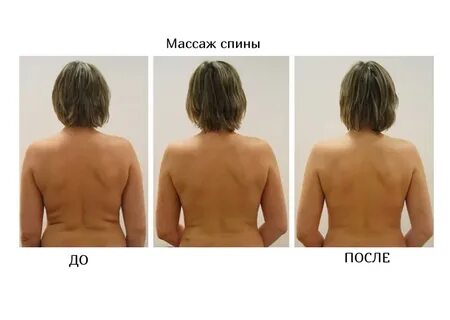 Липосакция спины