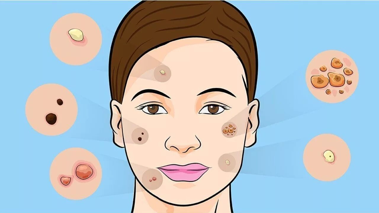 Acne program