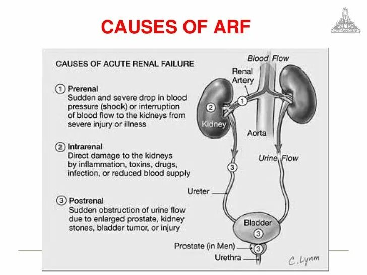 Acute renal failure. Renal impairment. Картинки анурия ренальная. Анурия латынь