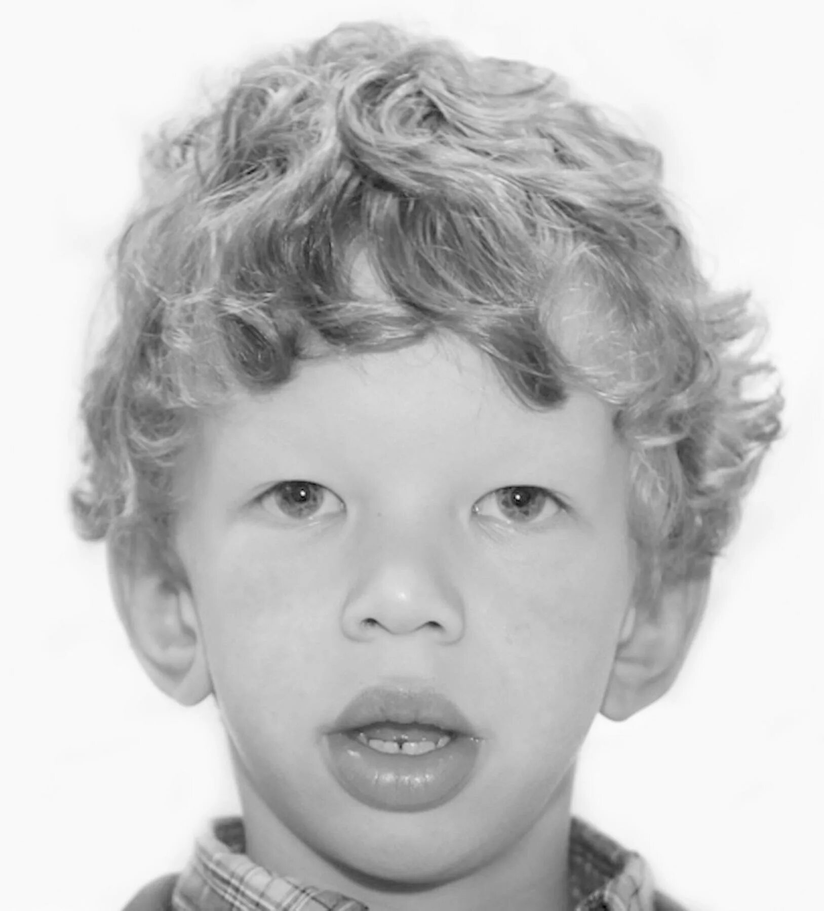 лицо эльфа синдром вильямса фото. синдром уильямса что это. синдром вильямса симптомы. синдром уильямса что это. при синдроме уильямса наблюдается.