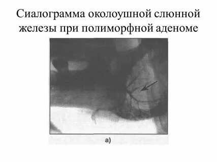 Злокачественные опухоли слюнных желез
