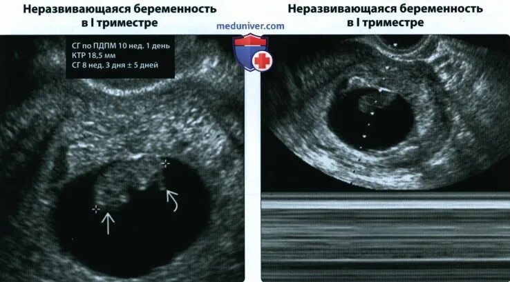 Патология плодного яйца. Как выглядит плодное яйцо в 4 недели.