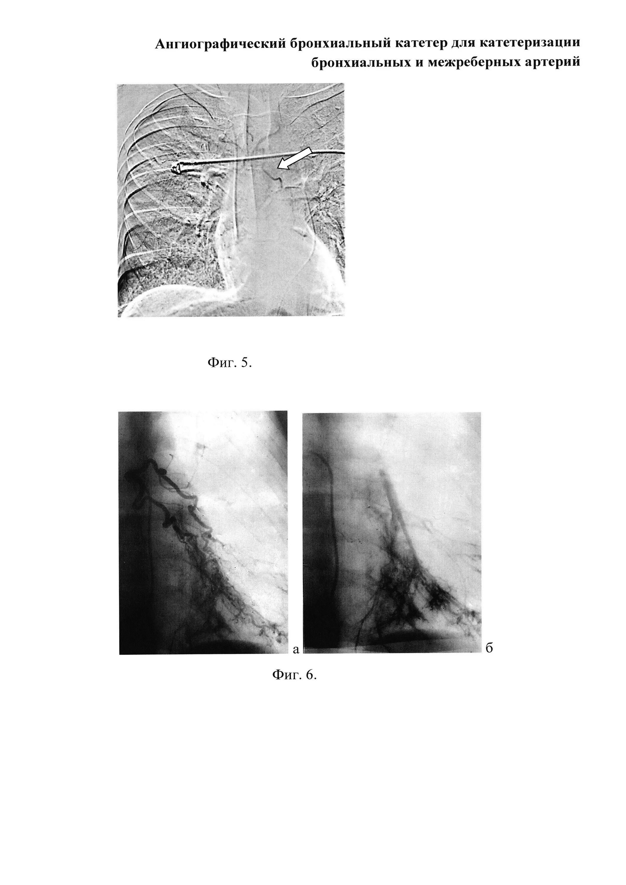 Катетер ангиографический. Катетеризация бронхов. Катетеризация грудной аорты. Ангиографический катетер. Введение катетеров в бронхи.