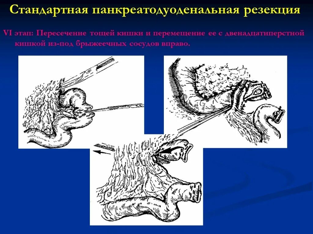 Пдр операция. Панкреатодуоденальная резекция. Стандартная панкреатодуоденальная резекция. Панкреато дуоденальная резекция. Стандартная гастропанкреатодуоденальная резекция.