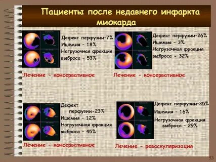 Индекс перфузии