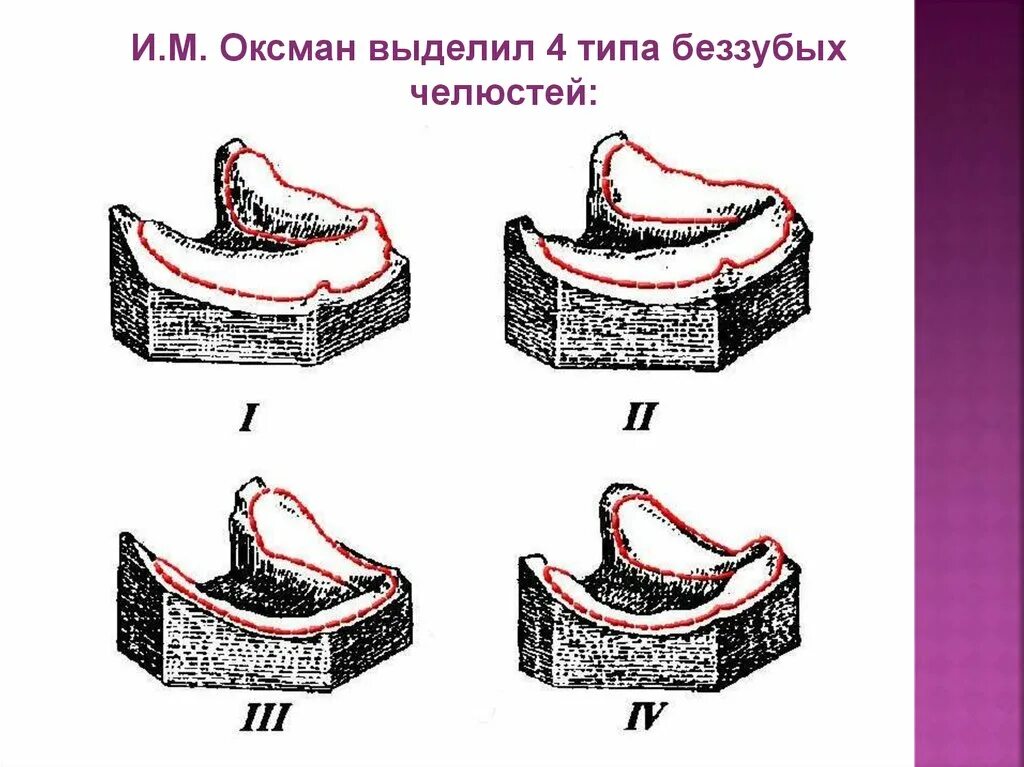 Классификации беззубых челюстей (Шредера, Келлера, Оксмана).. Оксман классификация беззубых челюстей. Классификация Шредера беззубых челюстей. Классификация Оксмана Шредера. Полная гребня