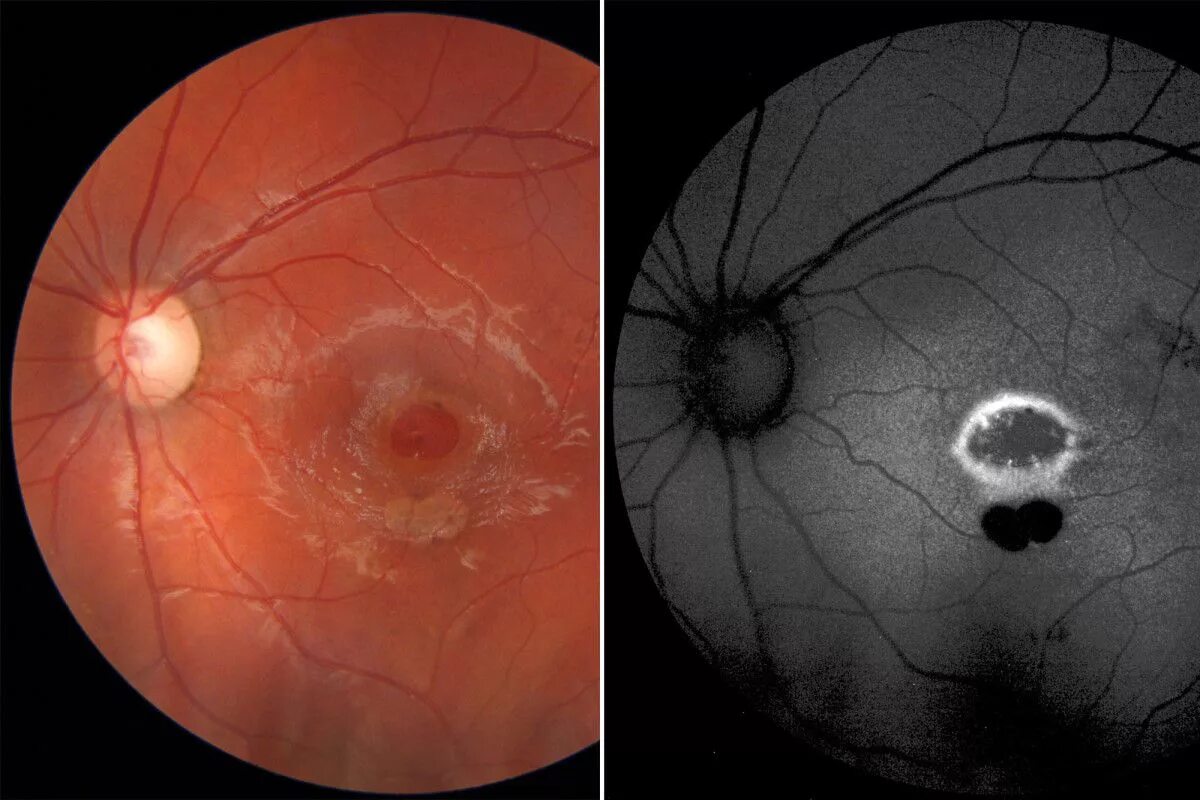 Повреждена сетчатка глаза.
