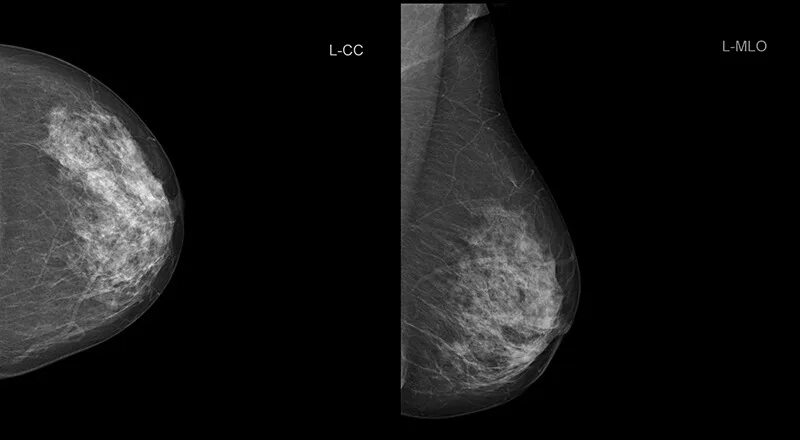 Маммография снимки