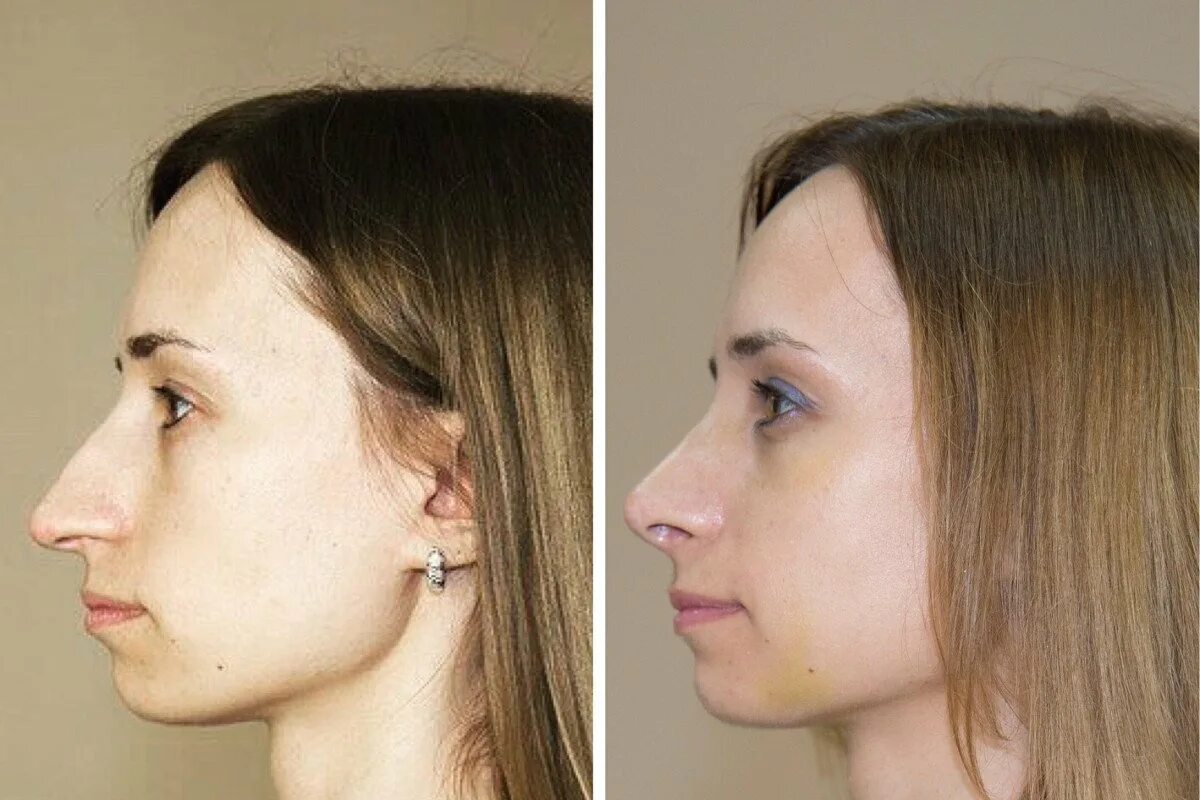 Где можно сделать нос. Седловидная форма носа ринопластика. Нос до и после ринопластики. Пластика носа до и после. Ринопластика длинного носа до и после.