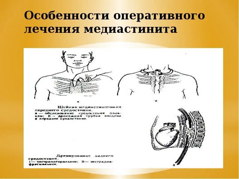 Медиастинит Оперативная хирургия. Оперативное лечение медиастинитов. Дренирование медиастинита. Медиастинит лечение