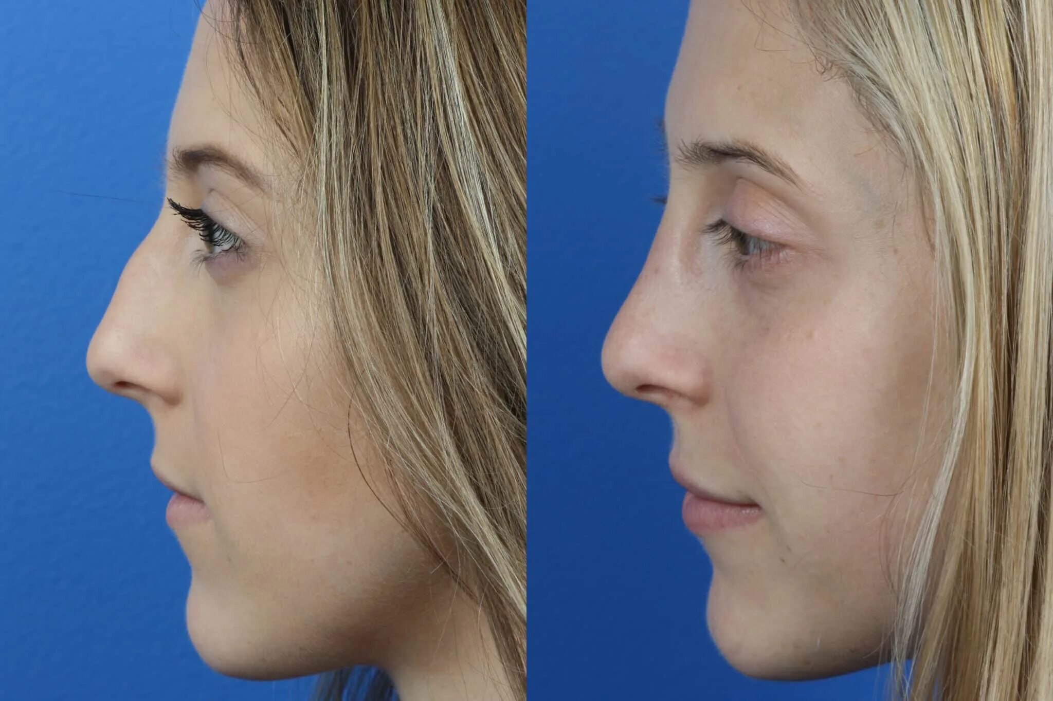 Cartilago Rhinoplasty. Rhinoplasty History. Rhinoplasty process. Rhinoplasty details.