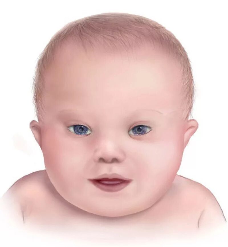 Голова дауна. Синдром Дауна. Лицо детей даунов. Лицо младенца.