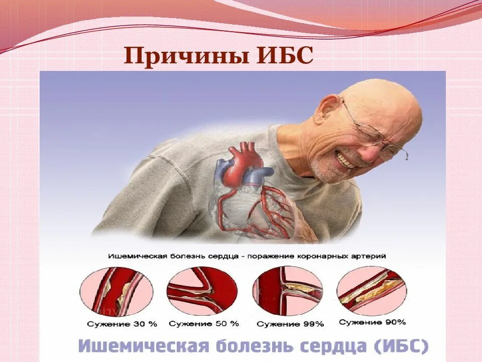 Ибс что это. Ишемическая болезнь сердца причины. причины развития ишемической болезни сердца. ибс ишемическая болезнь сердца симптомы. синдром ишемической болезни сердца симптомы.