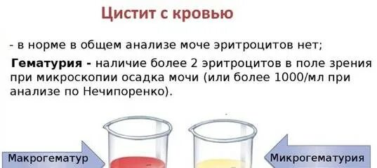 Кровь в моче при цистите. Моча с примесью крови. Обнаружение крови в моче это.