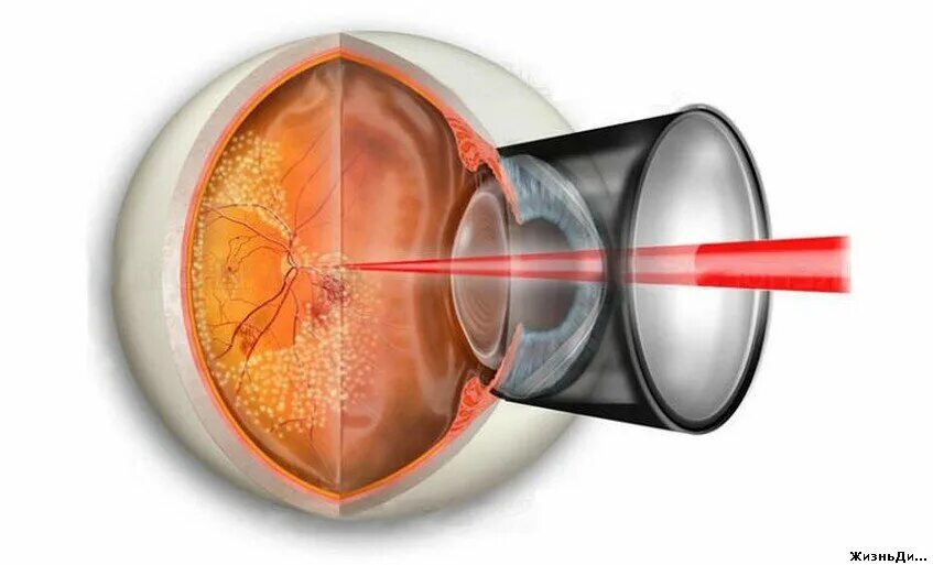 Ограничительная лазеркоагуляция сетчатки глаза. Барьерная лазеркоагуляция сетчатки. Отслойка сетчатки лазеркоагуляция. Периферическая лазеркоагуляция сетчатки глаза. Лазерная коагуляция после операции