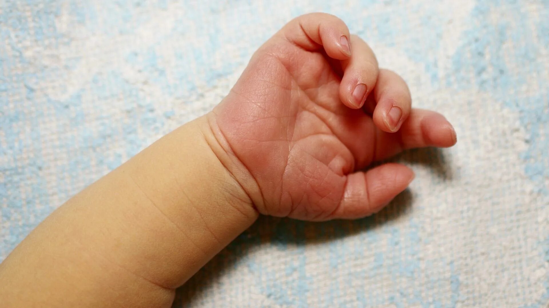 6 пальцев на руках у детей. Рождение детей без пальцев. Ребенок родился с тремя пальцами на руке. Родился с приросшими пальцами.