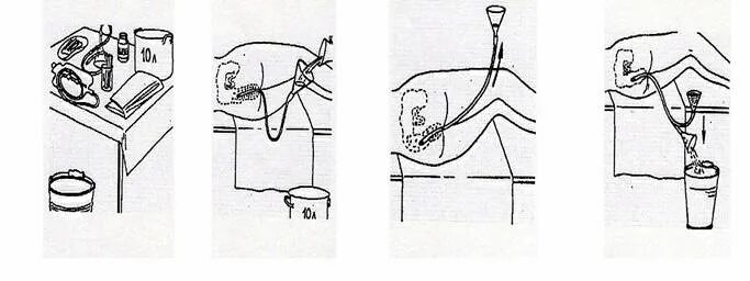Манипуляция очистительная клизма. Сифонная клизма алгоритм. Постановка сифонной клизмы алгоритм. Техника постановки сифонной клизмы. Методика постановки сифонной клизмы.