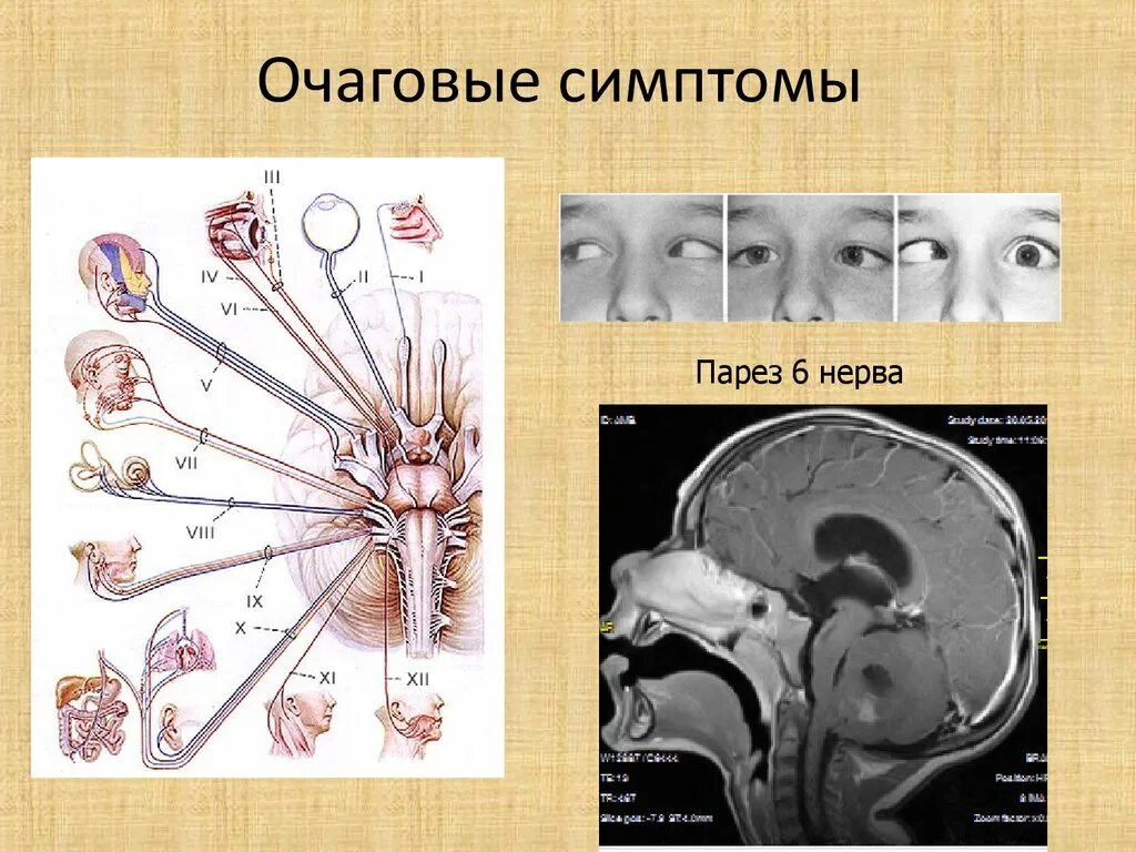 Очаговая неврологическая симптоматика. Очаговые неврологические симптомы. Очаговые симптомы в неврологии. Очаговые симптомы. Опухоли мозга неврология