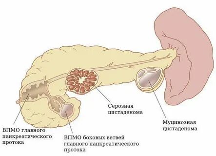 Киста поджелудочной железы симптомы