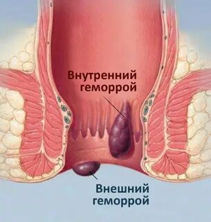 Чем лечить задний проход у женщин