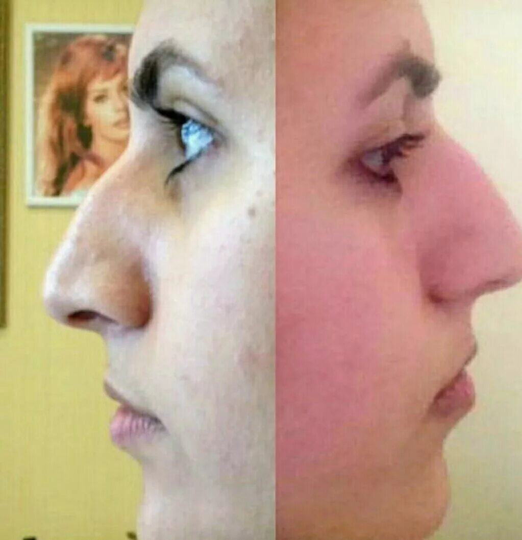 Упражнения для кончика носа. Упражнения для уменьшения носа. Упражнения для уменьшения но оса. Фейсбилдинг уменьшение носа до и после. Упражнения для уменьшения носа.