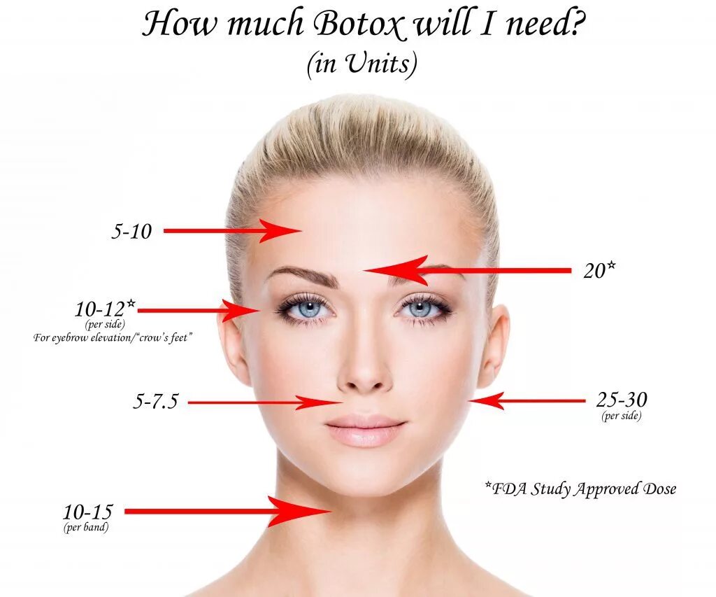 Сколько единиц ботокса в лоб. Ботокс схема. Лицо ботокс схема. Схема введения ботокса на лице. Схема уколов ботокса на лице.
