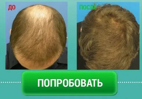 Средство для роста волос на залысинах