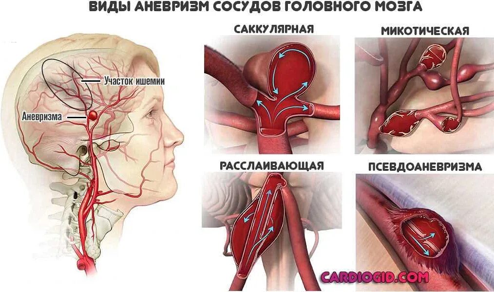 Аневризма головного мозга симптомы последствия лечение. Аневризма артерии головного мозга. аневризма глазной артерии. аневризмы артерий головного мозга классификация. саккулярная аневризма.