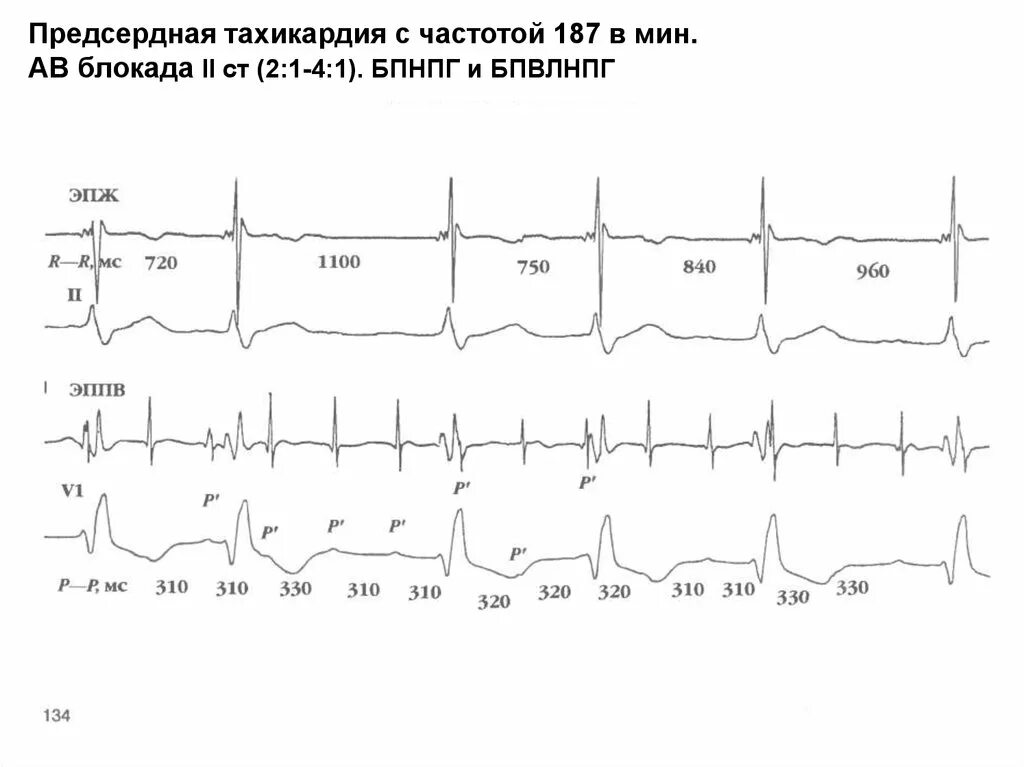 Предсердная блокада