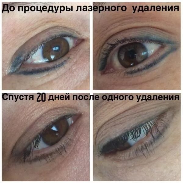 Через сколько можно мочить татуаж. Удалить стрелки татуаж. татуаж век после лазера.