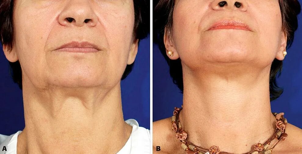 Шея после похудения. Омоложение шеи до и после. Липосакция подбородка и брылей. Медиальная платизмопластика. Шея после похудения.