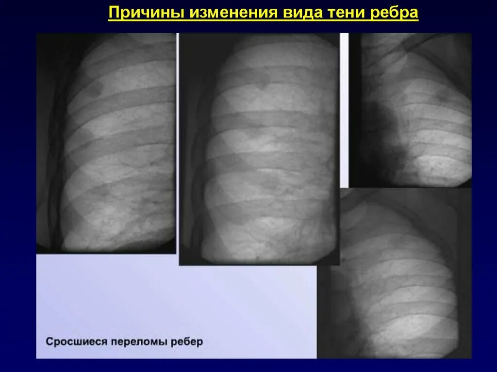 Трещина зажила. Рентген грудной клетки перелом ребер. Поднадкостничный перелом ребра. Сросшийся перелом ребра.