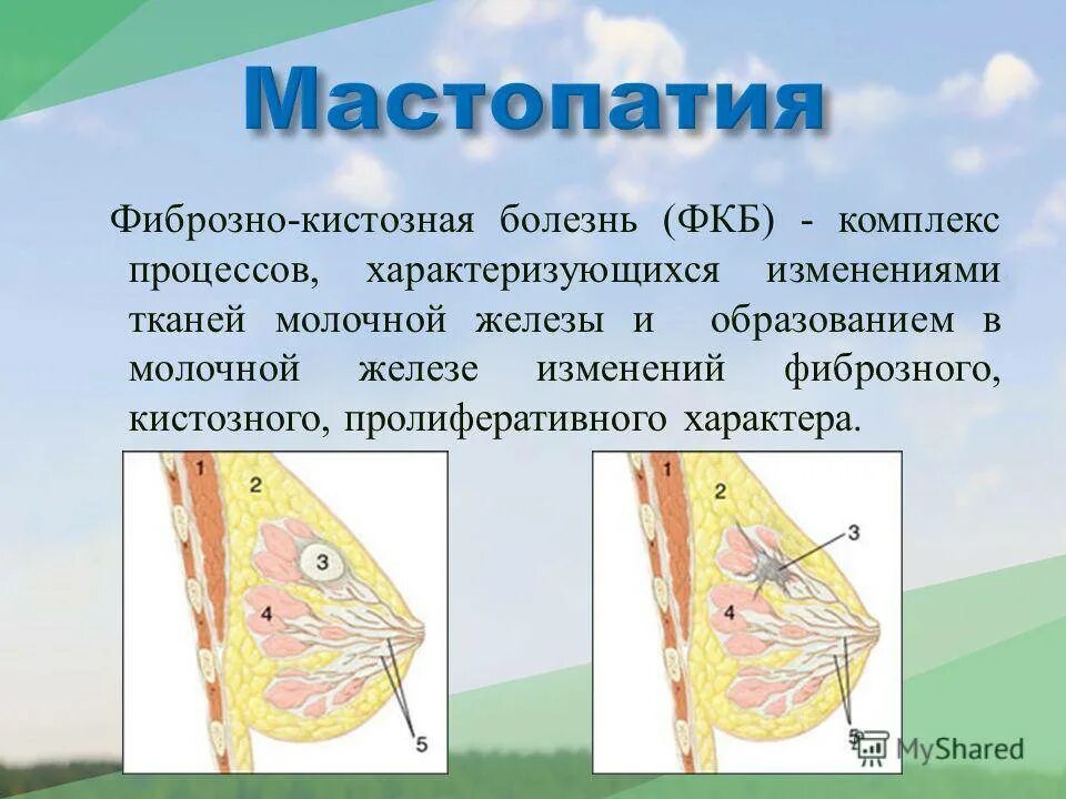 Диффузно-фиброзная мастопатия молочной железы. Фиброкистозная мастопатия молочной железы. Диффузия фиброзно-кистозной мастопатии молочных желез. Фиброзная мастопатия молочной железы что это. Двухсторонняя диффузная