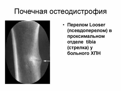 Почечная остеодистрофия