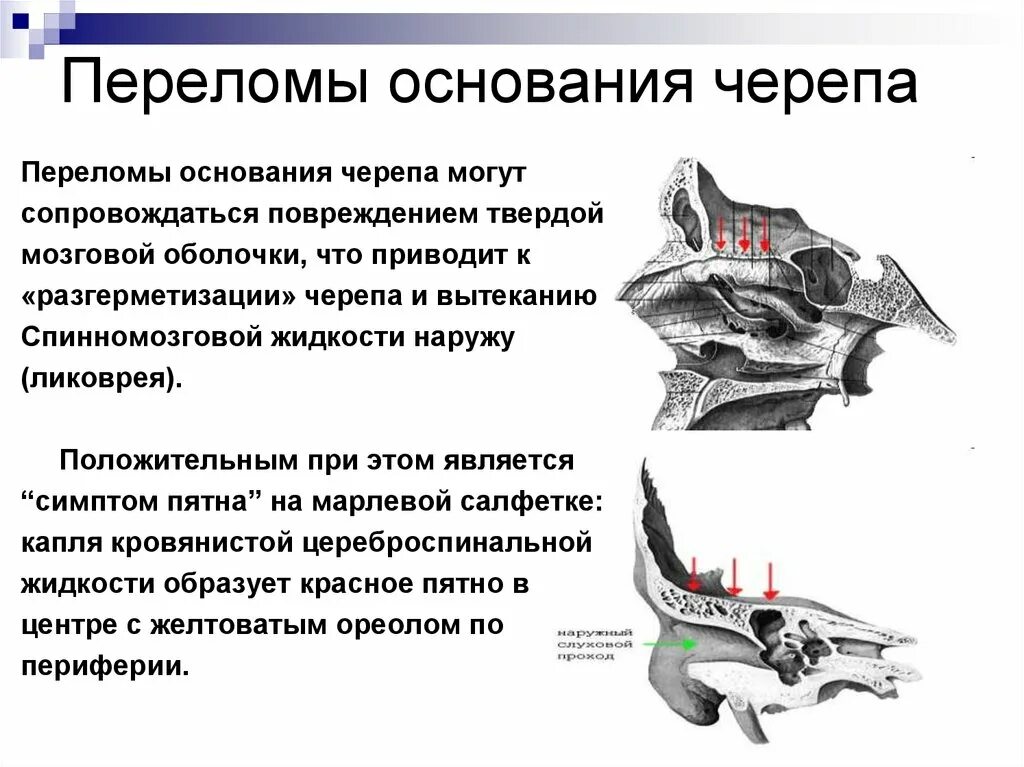 Для перелома основания черепа характерно. Достоверным симптомом перелома основания черепа является. Перелом костей основания черепа. При переломе основания черепа. Перелом основания черепа симптомы.