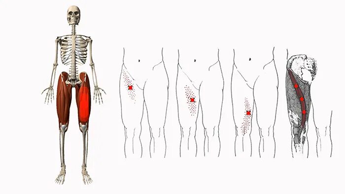 Триггерные точки портняжная мышца. Триггерные точки бедра. Портняжная мышца бедра иннервация. Миофасциальный синдром квадратной мышцы поясницы. Болит правая нога и отдает в пах