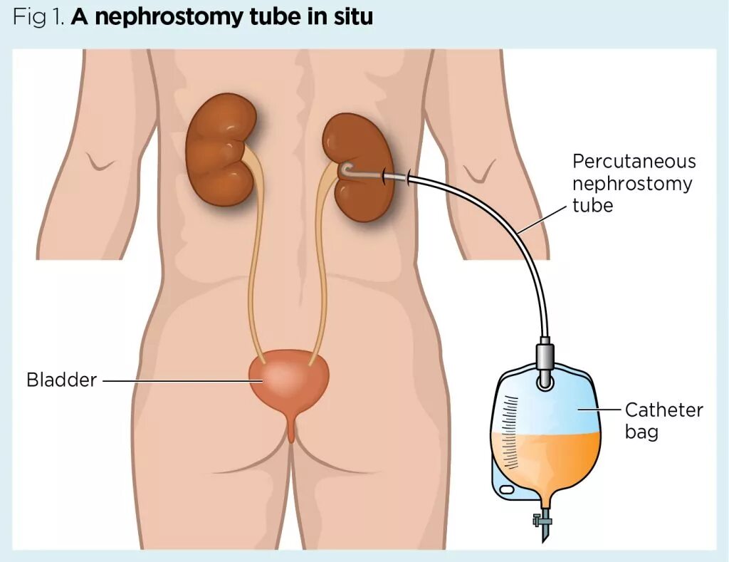 Трубочку в мочевой пузырь. Нефростома катетер. Пункционная нефростомия. Почечный катетер для нефростомы.