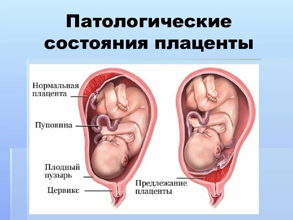 Плацента на какой неделе. Плод центральное предлежание плаценты. Краевое и центральное предлежание плаценты. Предлежание плаценты переднее и заднее. Нормальное предлежание плаценты.