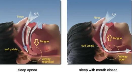 Схема лечения аденоидов у детей 3 лет. Аденоиды 2 степени у ребенка 3 года. Упражнения для лечения аденоидов. Как облегчить сон при аденоидах. Как облегчить сон при аденоидах.