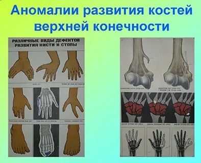 Аномалия ноги