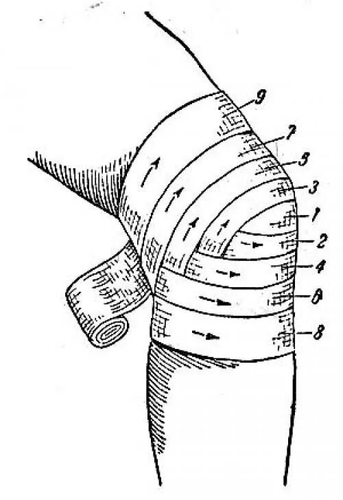 Черепашья сходящаяся на коленный сустав повязка. Черепашья повязка колосовидная повязка. Черепашья повязка на локтевой и коленный сустав. Черепашья повязка на коленный сустав. Как перевязывать колено