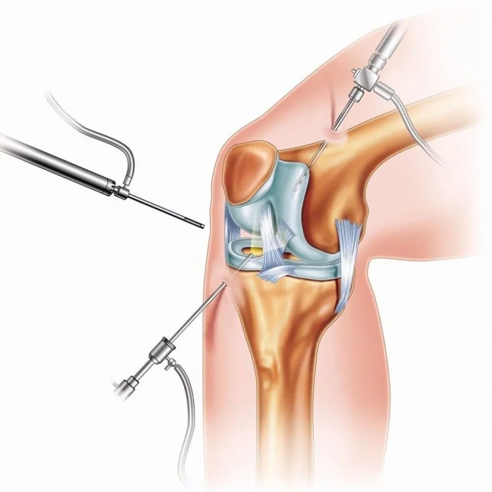 Цито коленный сустав. Артроскопия мениска коленного сустава операция. Артроскопическая резекция мениска коленного сустава. Артроскопия коленного сустава разрыв мениска.