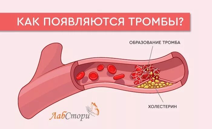 Образование тромбов в артериях. Став тромбы