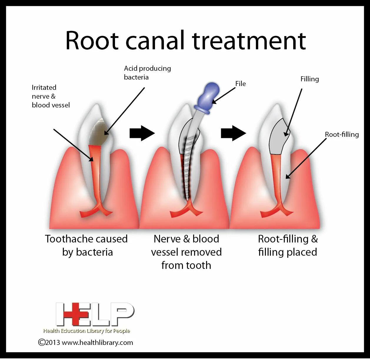 Root canal. Dental treatment Tooth.